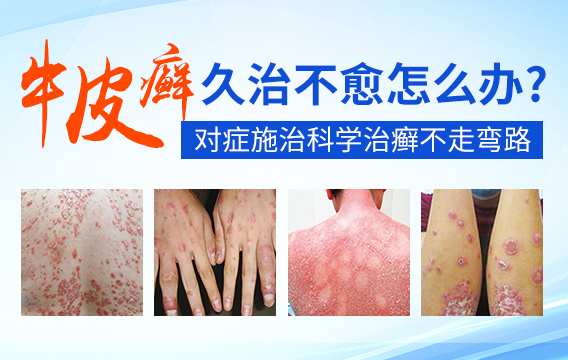 牛皮癣与普通皮肤病的区别